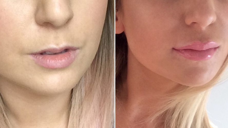 What it really feels like to have lip fillers Marie Claire