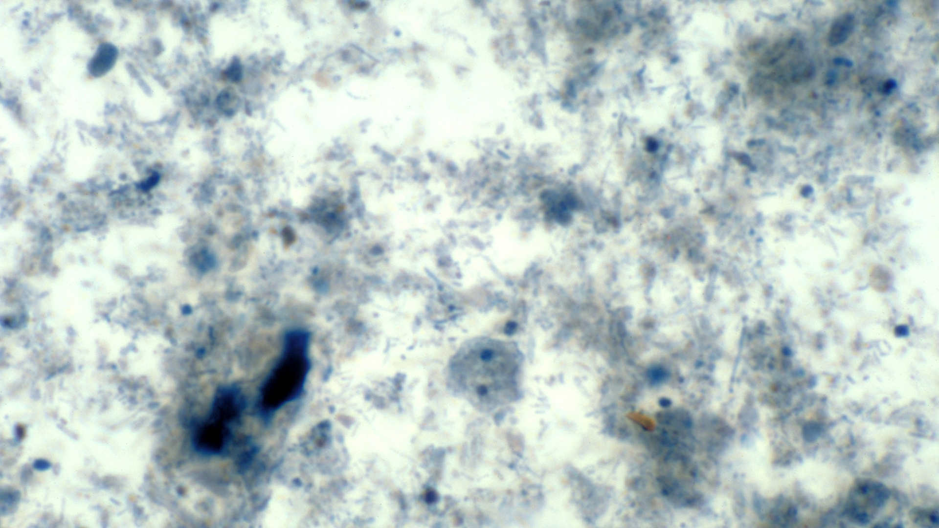 This iron-hematoxylin stained photomicrograph depicts a binucleated amoebic trophozoite of a Dientamoeba fragilis parasite.