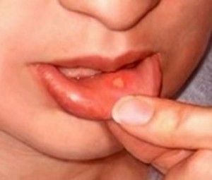 Tongue water blister under Oral mucous