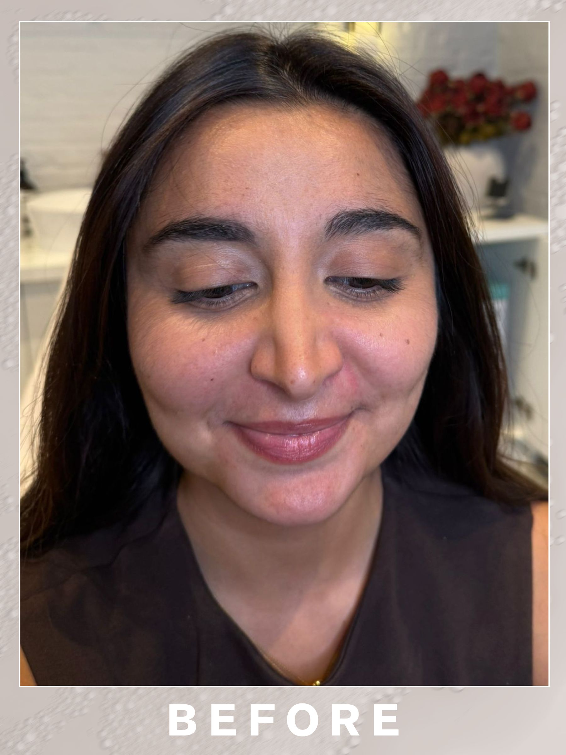 Senior shopping editor Marina Avraam before having nasolabial filler