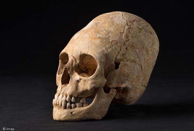 deformed skull from the dark ages in france