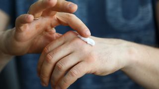 man with eczema applying moisturizer to his hands