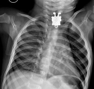 An X-ray shows a SpongeBob pendant that a toddler swallowed.