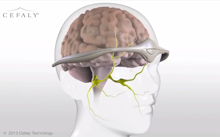 The FDA just approved a high-tech tiara to prevent migraines, without drugs