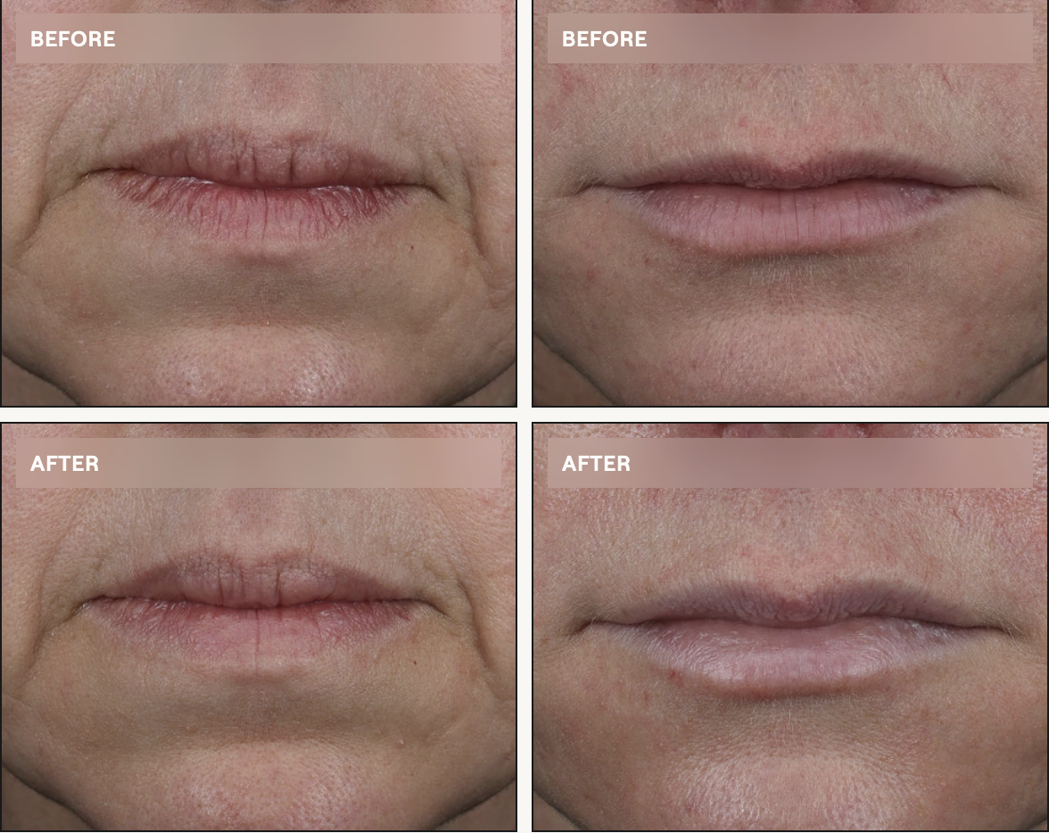 before and after photos from dr diamonds lip lift