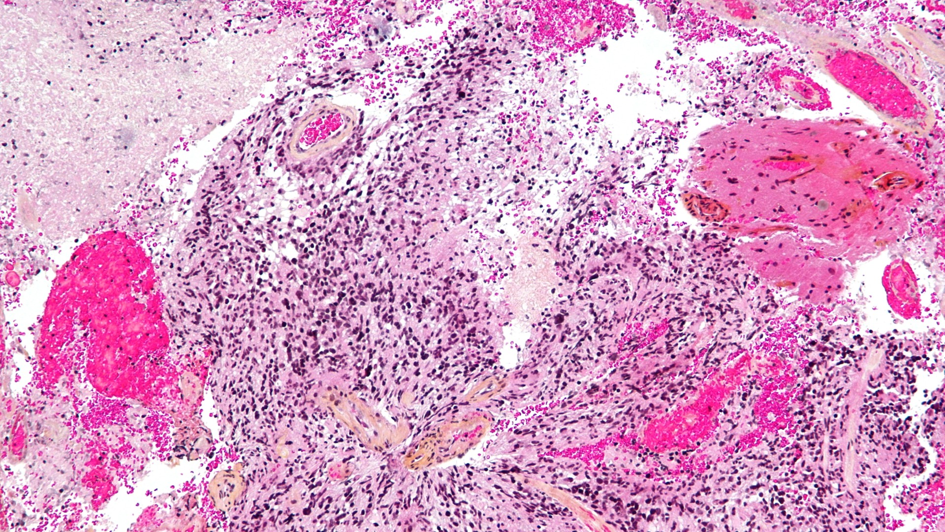 Multi-colored microscope image of glioblastoma up close under the microscope. There's lots of black spots dotted around the image, with larger, circular hot pink patches, as well as lighter pink and light yellow patches of different shapes/sizes. White gaps are seen between them.