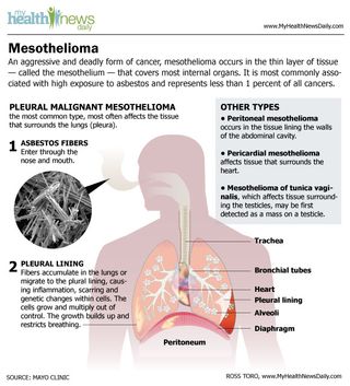 Mesothelioma is an aggressive form of cancer that occurs in a thin layer of tissue that covers most internal organs.