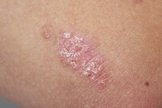 Psoriasis on a person's skin.