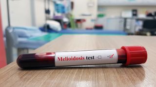 Blood sample tube labeled with &quot;melioidosis test.&quot;