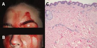 On the left, an image of the woman's face during a bleeding episode. On the right, an image of the woman's skin under a microscope, which showed normal tissue.