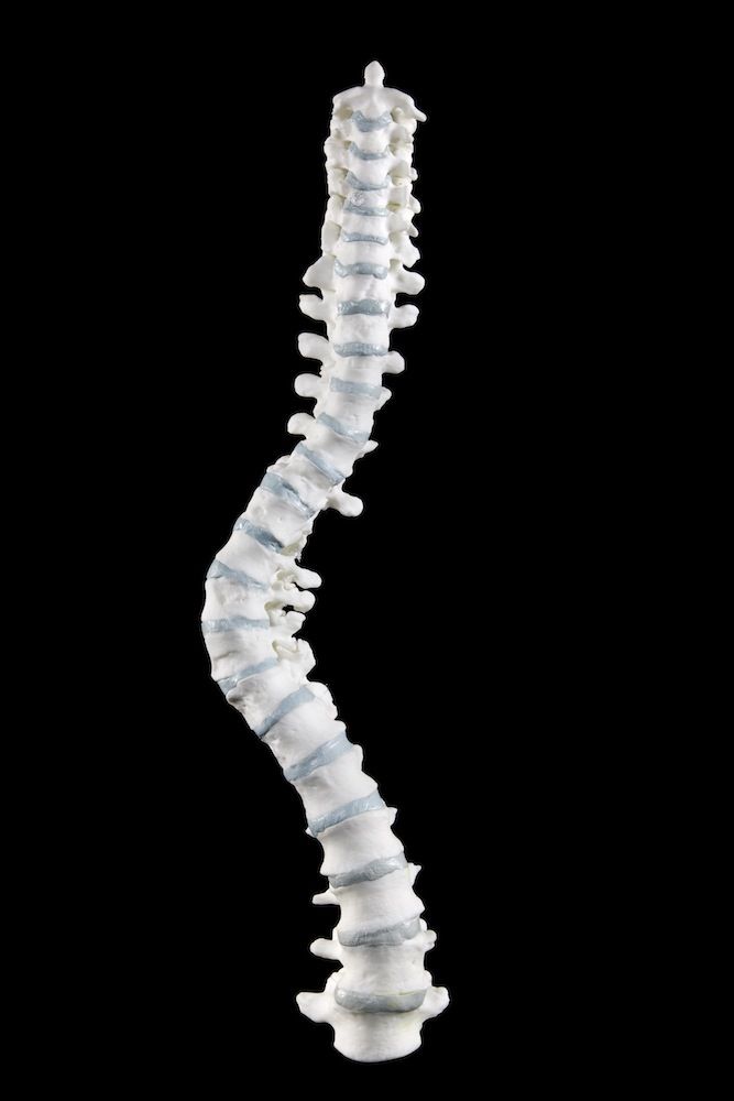 three dimensional model of spine with scoliosis