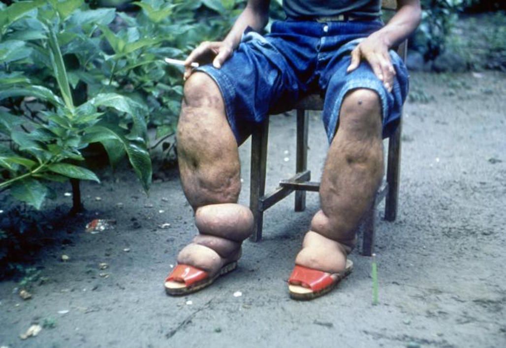 elephantiasis, swellling, parasite