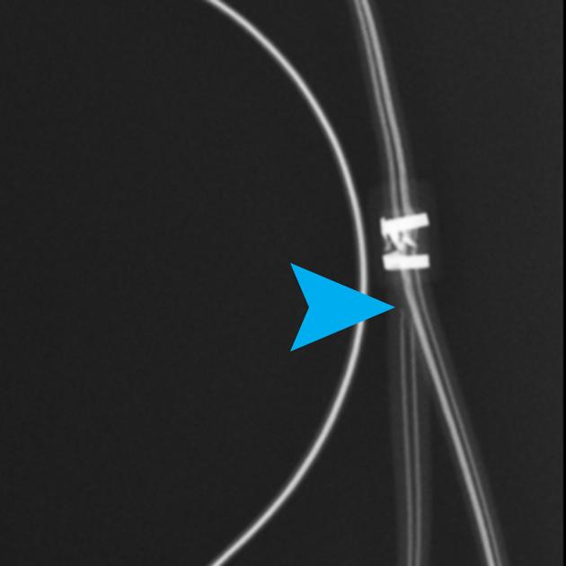 The blue arrow shows the tear in the wires close to the splitter.