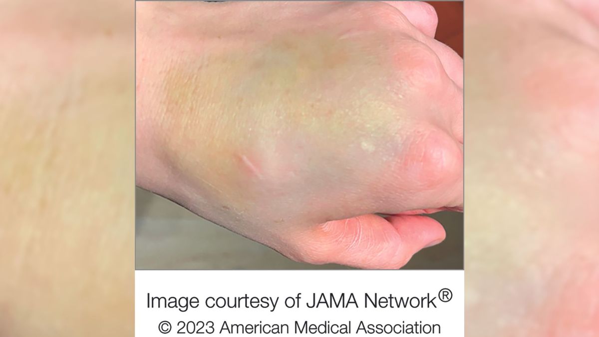 photo shows the back of a white person&#039;s left hand, which bears a large, greenish bruise