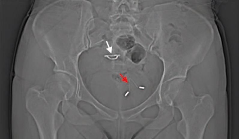 An X-ray showing a woman&#039;s displaced IUD in her bladder.