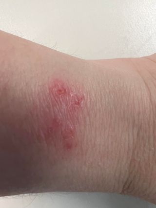 Fitbit burn lawsuit