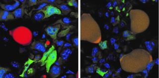 Scientists have turned some cancer cells into fat cells in mice. The image on the left shows cancer cells that glow green because they express a "green fluorescent protein," and fat cells that are stained red, within a mouse tumor. The image on the right 