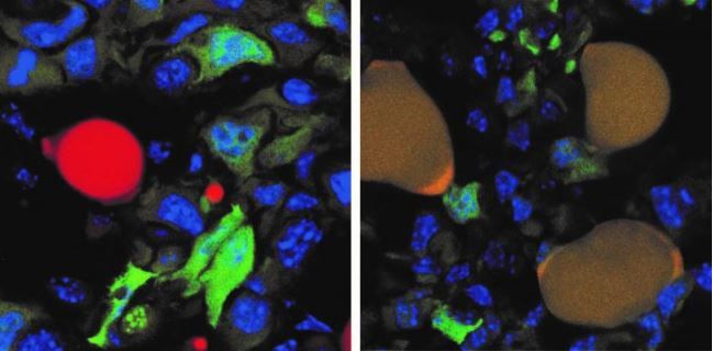 Scientists have turned some cancer cells into fat cells in mice. The image on the left shows cancer cells that glow green because they express a &quot;green fluorescent protein,&quot; and fat cells that are stained red, within a mouse tumor. The image on the right 