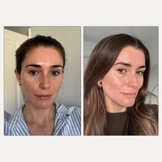 Before and after using Klira tretinoin treatment