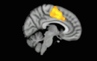 MRI brain scan of apathetic brain