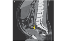 A computed tomography of the man&rsquo;s abdomen and pelvis shows the calcification of his bladder and part of his bowel.