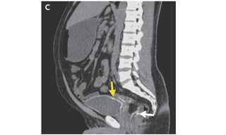 A computed tomography of the man’s abdomen and pelvis shows the calcification of his bladder and part of his bowel.