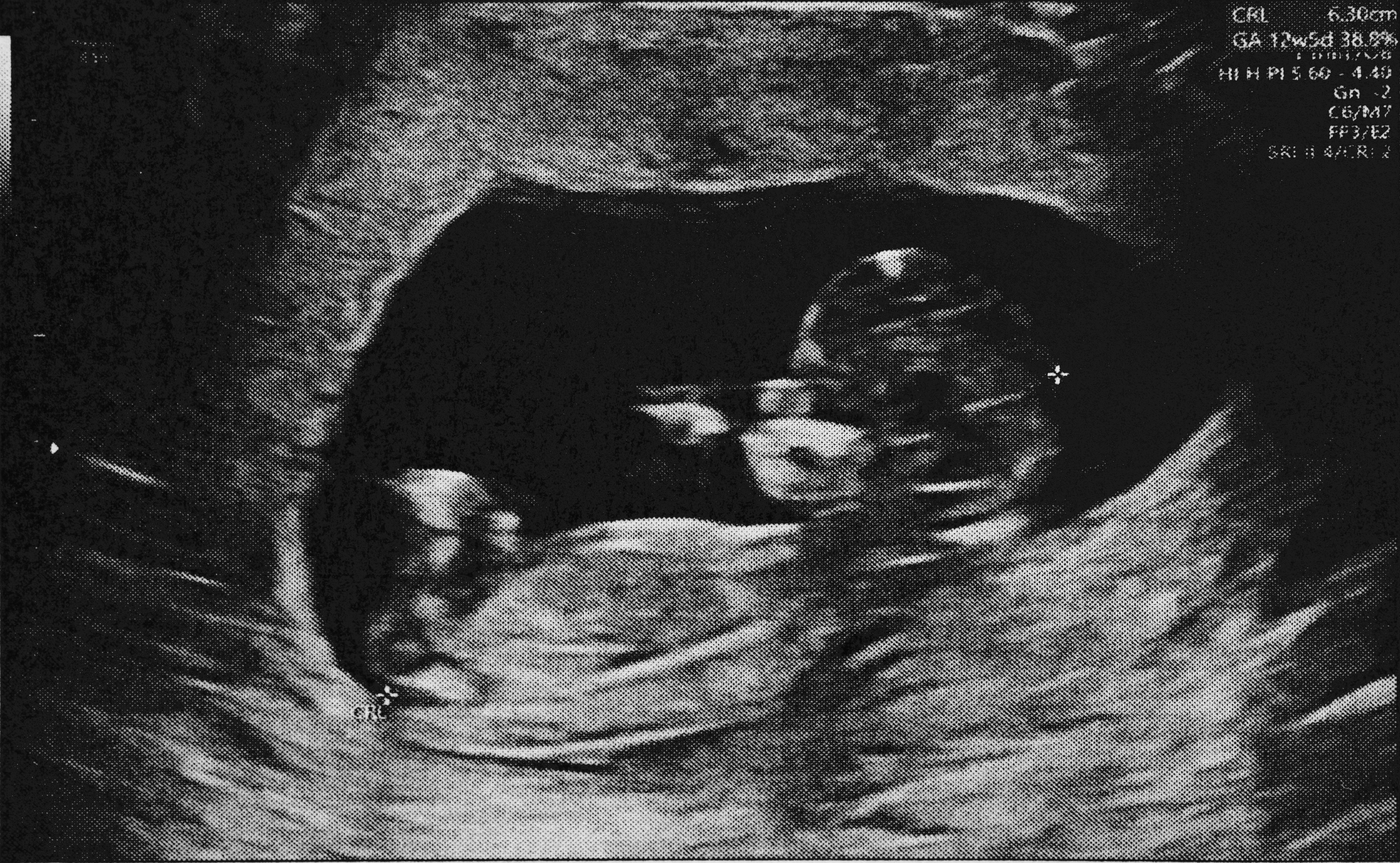 an ultrasound image showing a fetus in the womb