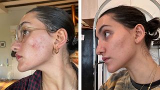 before and after photos from aviclear laser treatment facial