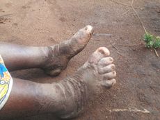 podoconiosis, elephantiasis