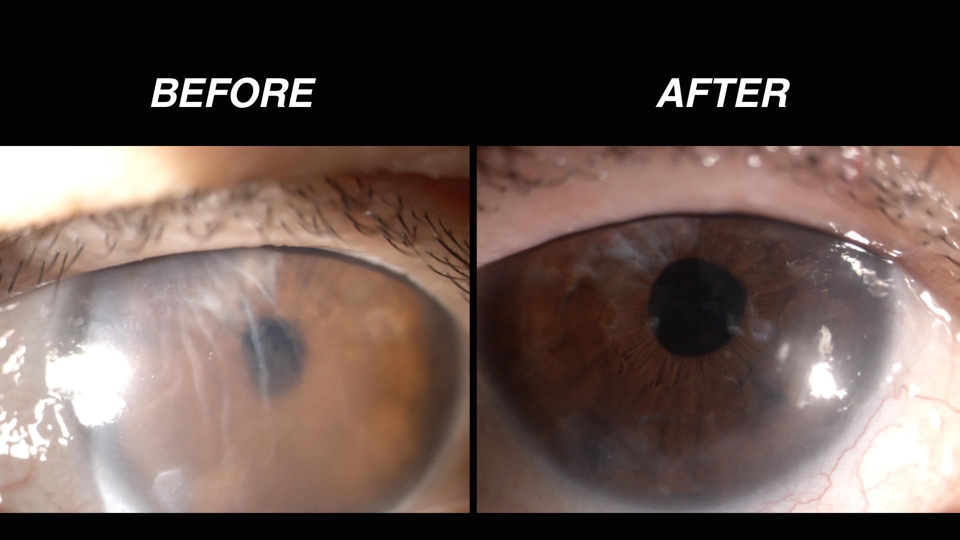 Two images show close ups of eyes, one with a cloudy lens and the other with a clear lens