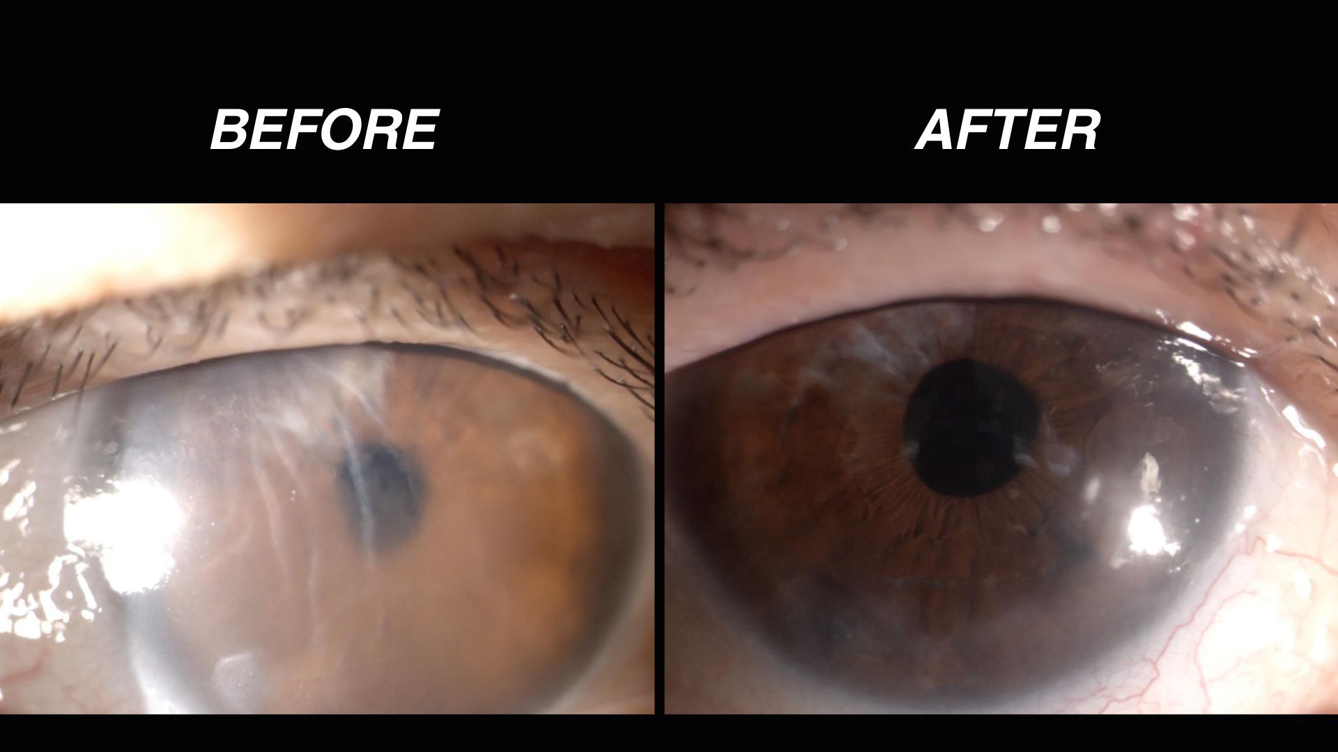 Two images show close ups of eyes, one with a cloudy lens and the other with a clear lens