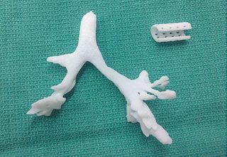 Using a 3D printer, researchers created an airway splint. Shown above, a printed model of the splint and the child's airway and bronchus.