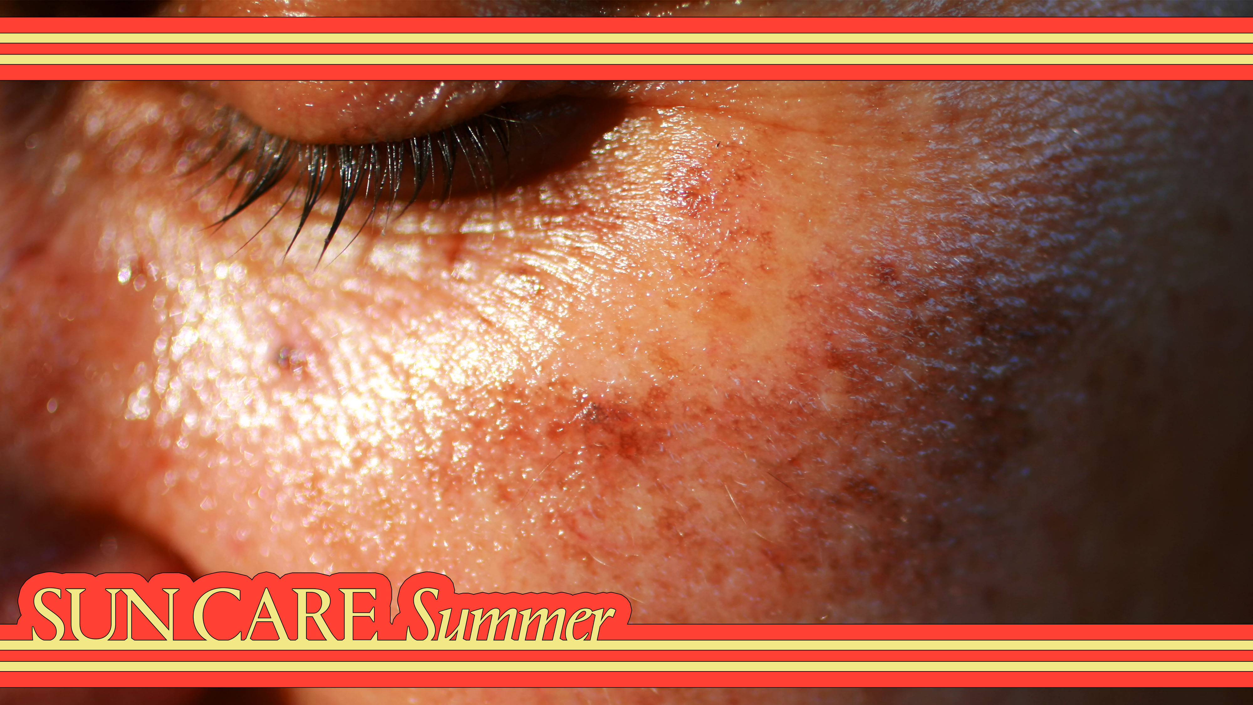 So You Have Melasma—Let's Talk Treatment