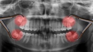 wisdom teeth seen over X-ray.