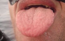 swollen tongue