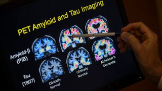 close up on a person's hand as they use a pen to point at an image of 6 brain scans, labeled "PET amyloid and tau imaging"
