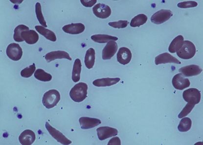 Study finds that bone marrow transplants can reverse sickle cell disease in adults