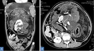 A CT scan showing a mass in the teen's stomach with "multiple calcified densities," i.e. bones.