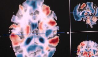 fMRI brain scan