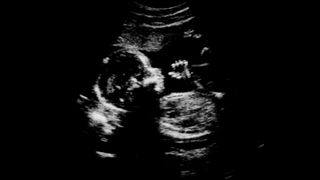 Monochrome, Monochrome photography, Black-and-white, Medical, Medical imaging, Radiology, Obstetric ultrasonography,