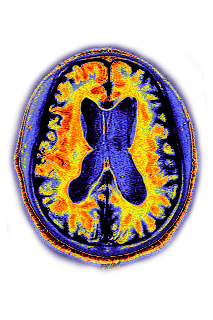 color-coded brain scan of alzheimer's, with yellow and red brain regions with atrophy shown in purple