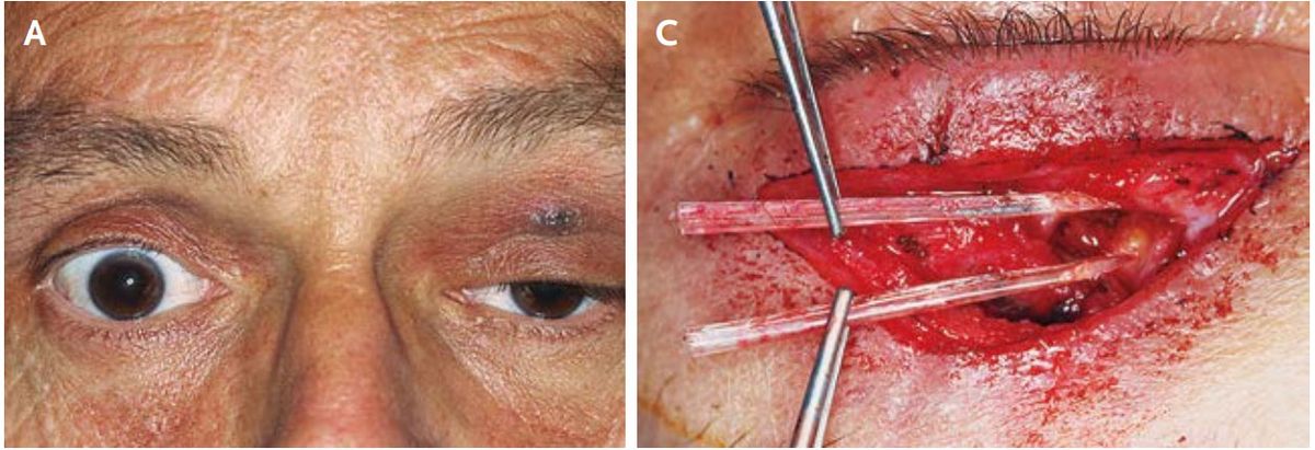 Doctors found the jaws of a fish in the eyelid of a man who went swimming in the Red Sea. On the left, an image of the man&#039;s droopy eyelid. On the right, an image of the fish jaws removed during surgery.