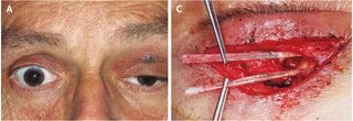 Doctors found the jaws of a fish in the eyelid of a man who went swimming in the Red Sea. On the left, an image of the man&#039;s droopy eyelid. On the right, an image of the fish jaws removed during surgery.