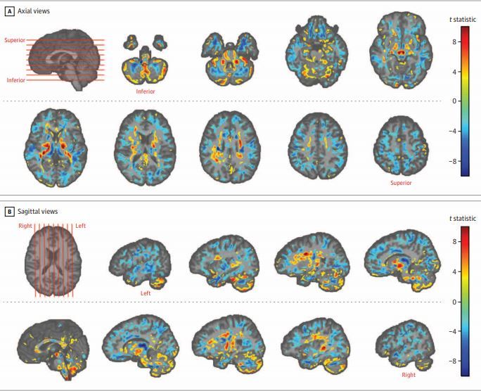 U.S. embassy workers who experienced unusual sensations while serving in Cuba show differences in their brain tissue, compared with healthy people, a new study finds. In the above brain images, the red and yellow colors indicate areas with higher brain vo