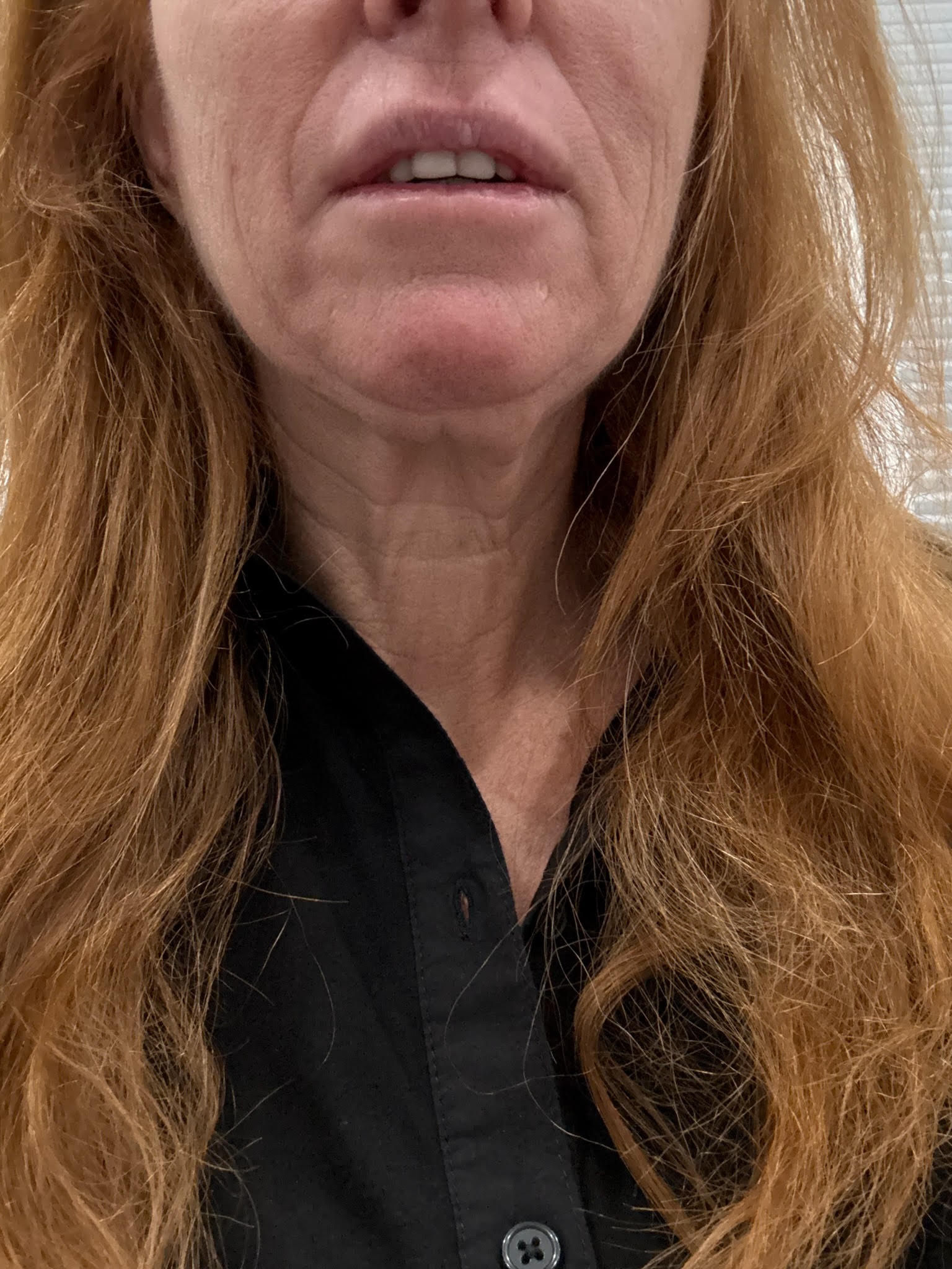 Jenny Hutt's neck before surgery.