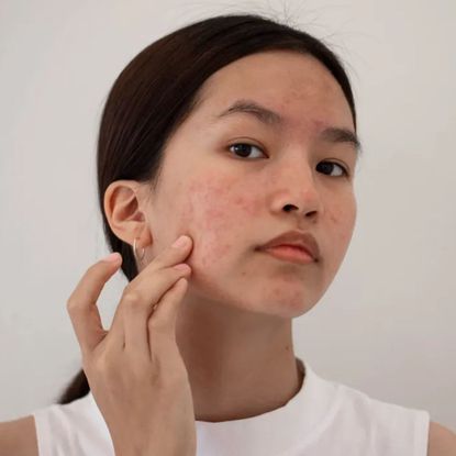 Woman feeling her acne-prone skin