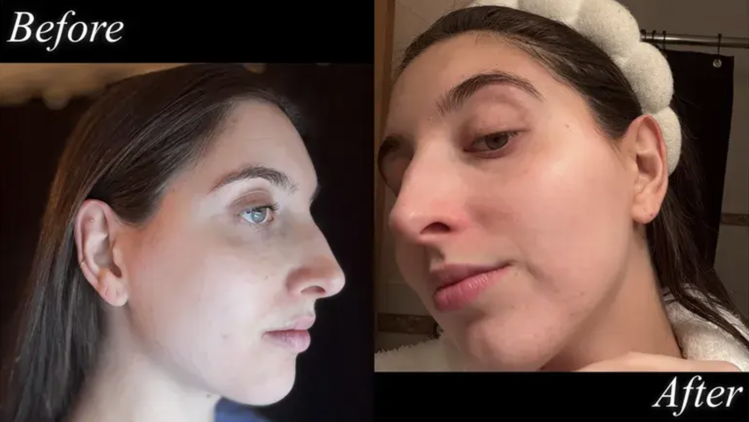 Beauty editor Marisa Petrarca both before and after using a Dermaflash+ device to dermaplane her face.