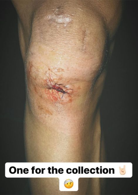 Mathieu van der Poel knee injury