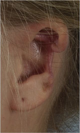 This is the ear after the dead tissue was removed.