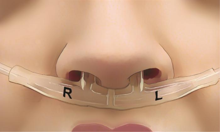an illustration of a person's nose with tubes that measure airflow